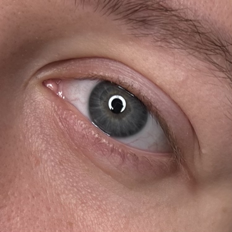 eye before 2
