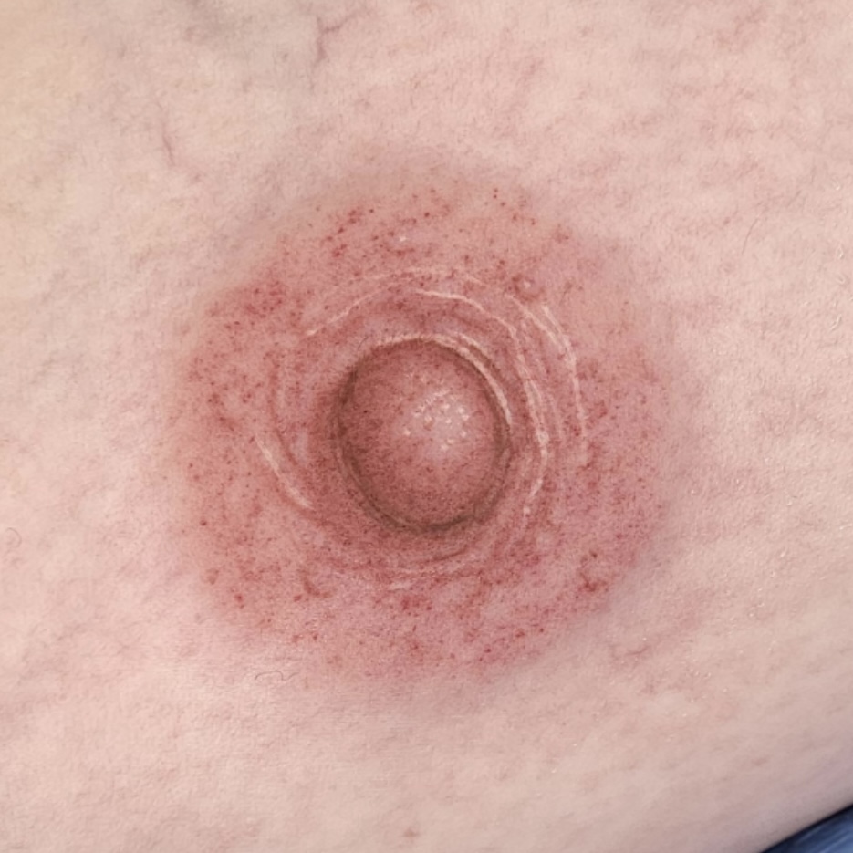 3D Areola Tattoo vs. Custom Silicone Nipple Prosthesis: Which Option Is Right for You? 3D areola tattoo after breast reconstruction