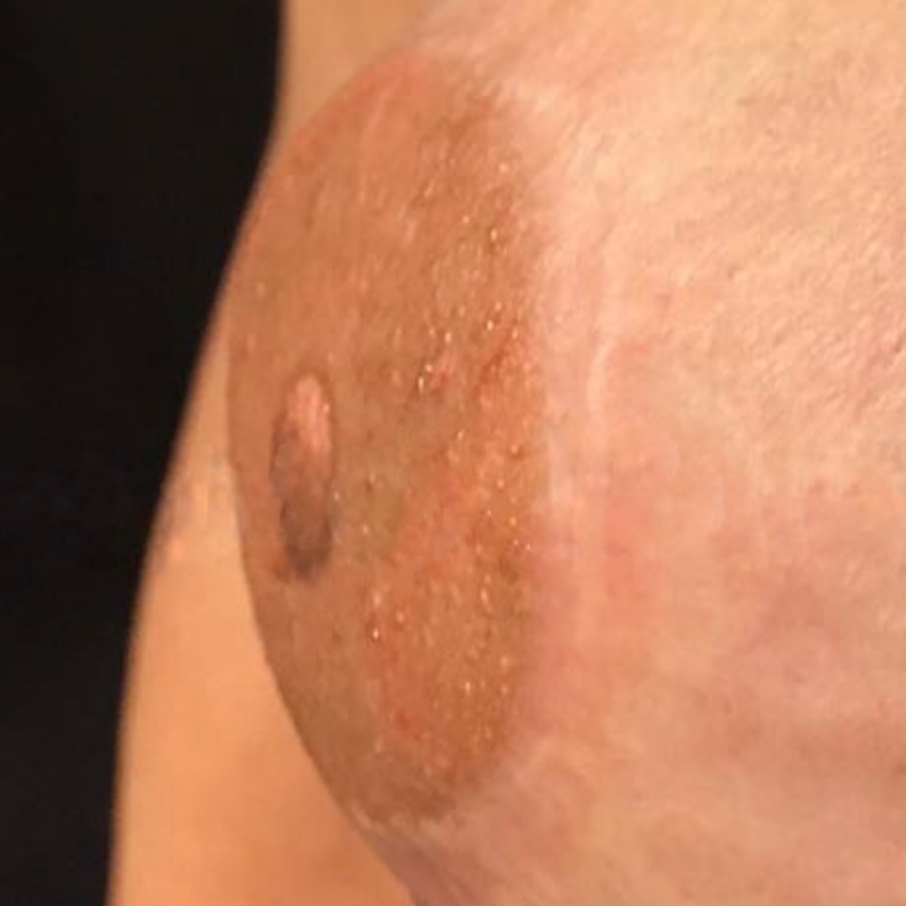 3D Areola Tattoo vs. Custom Silicone Nipple Prosthesis: Which Option Is Right for You? 3D areola tattoo creates the visual illusion of a raised nipple