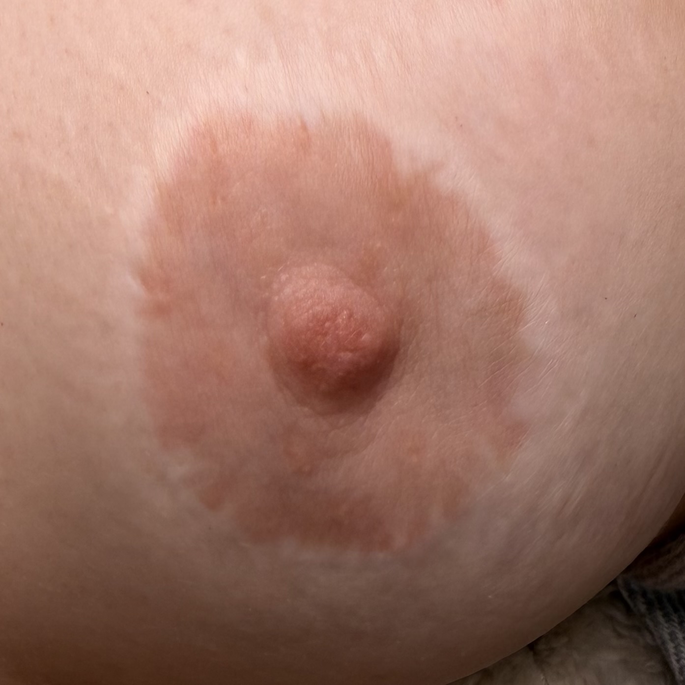 3D Areola Tattoo vs. Custom Silicone Nipple Prosthesis: Which Option Is Right for You? Areola before partial colour restoration after breast surgery