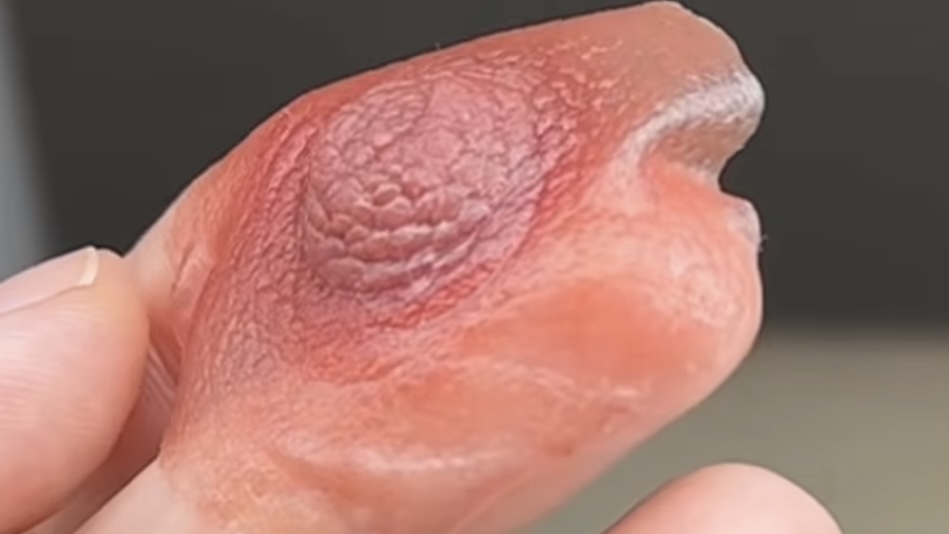 3D Areola Tattoo vs. Custom Silicone Nipple Prosthesis: Which Option Is Right for You? xt Custom silicone nipple prosthesis after mastectomy